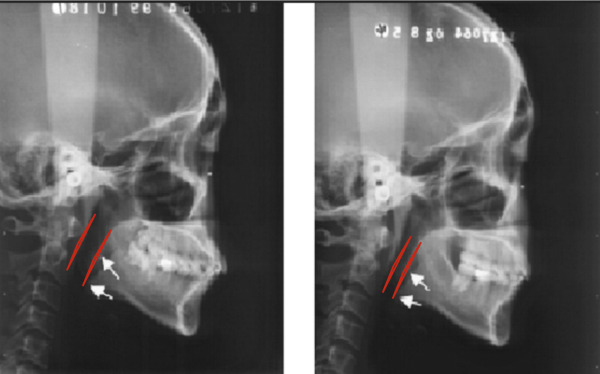 Fig. 3. Traditional Orthodontics reduces the airway by shortening the upper and lower jaws (maxilla and mandible) and moving them backward (After the Journal of Clinical Orthodontics).  This reduction can be seen in many otherwise excellently treated orthodontic cases